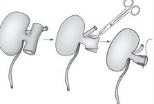 Cấy ghép thận - Kidney Transplantation Abhinav Humar and Arthur J. Matas
