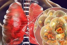 Bệnh viêm phổi lạ Trung Quốc