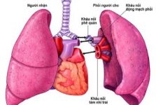 Quy trình ghép phổi